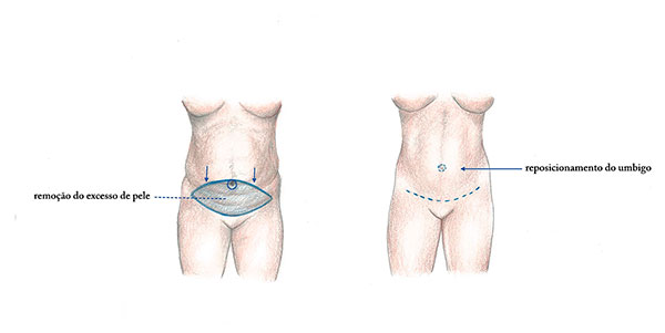 desenho da cirurgia de abdominplastia para retirada de pele