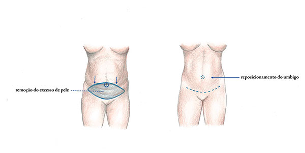 Abdominoplastia desenho da cirurgia de abdominplastia para retirada de pele