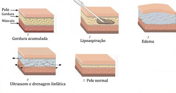 tratamento de edema com ultrassom e drenagem linfática pós lipoaspiração