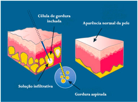 Célula de gordura recebe solução de Klein solução de klein incha a célula de gordura e facilita lipoaspiração