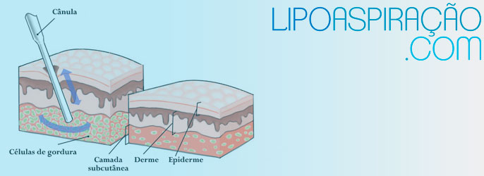 diagrama da retirada de gordura localizada por sucção através de microcânula durante lipoaspiração